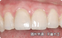 全瓷冠是什麼、全瓷冠推薦、全瓷牙冠