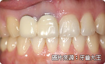 全瓷冠是什麼、全瓷冠推薦、全瓷牙冠