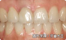 全瓷冠是什麼、全瓷冠推薦、全瓷牙冠