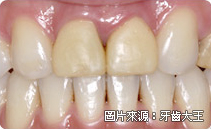 全瓷冠是什麼、全瓷冠推薦、全瓷牙冠