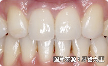 全瓷冠是什麼、全瓷冠推薦、全瓷牙冠