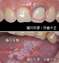 全瓷冠是什麼、全瓷冠推薦、全瓷牙冠