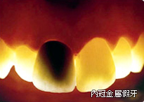 全瓷冠是什麼、全瓷冠推薦、全瓷牙冠