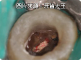 高雄推薦顯微鏡根管治療