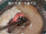 高雄推薦顯微鏡根管治療