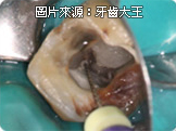 高雄推薦顯微鏡根管治療