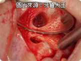 高雄推薦顯微鏡根管治療
